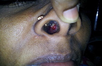 bleeding-polypus-nose